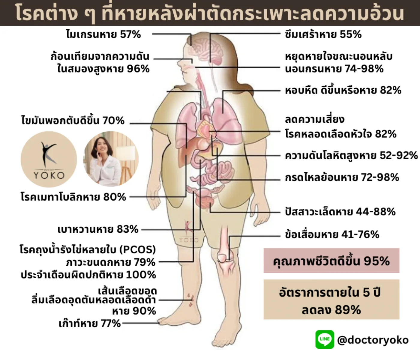 โรคร่วมที่ดีขึ้นหลังผ่าตัดกระเพาะลดน้ำหนัก